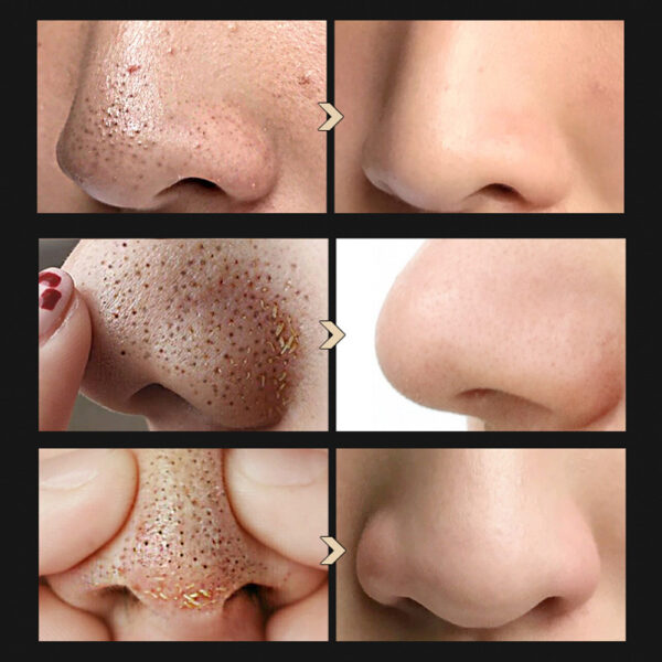 Blackhead Shrinking Combination Kit - Image 4