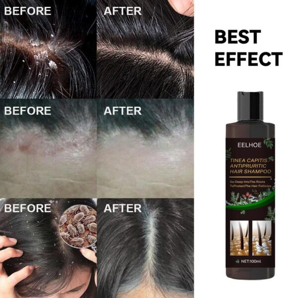 EELHOE Anti-Dandruff Shampoo - Itch Relief, Hair Loss Prevention, Oil Control & Refreshing Care - Image 4